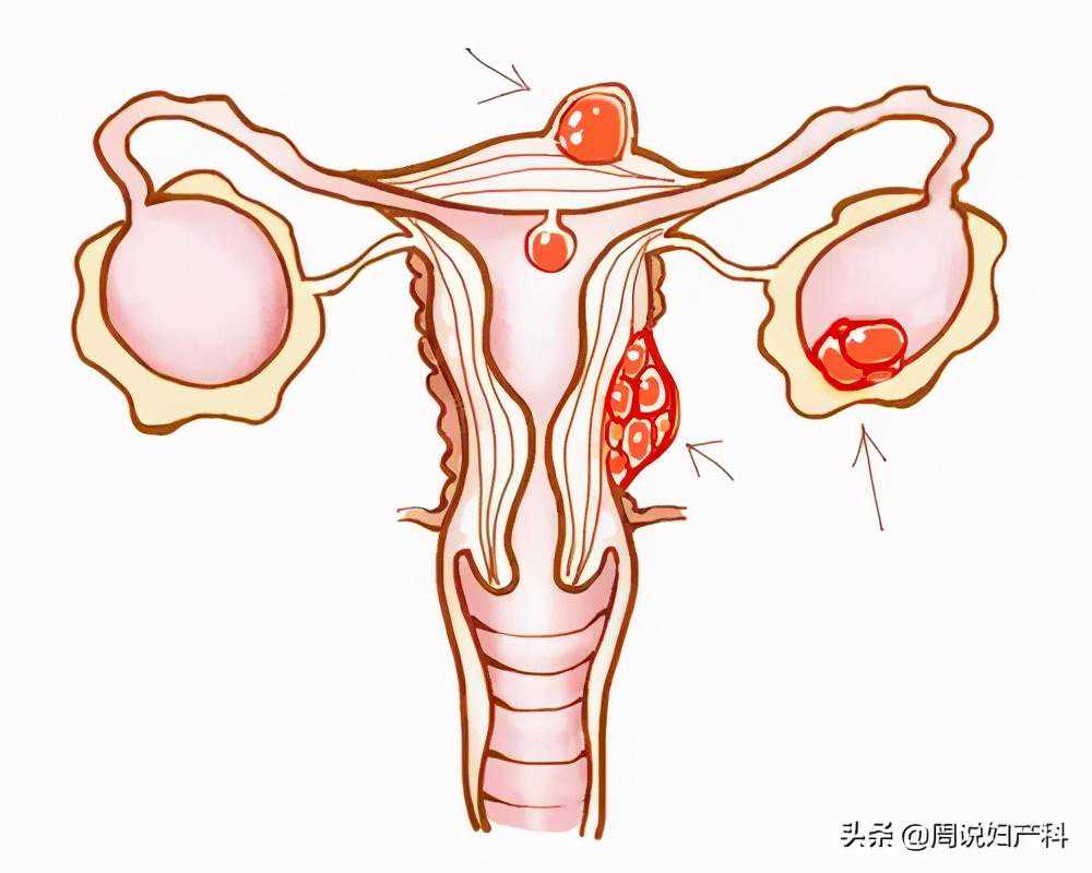 女性经期咳血是怎么回事？会是子宫内膜异位症吗？